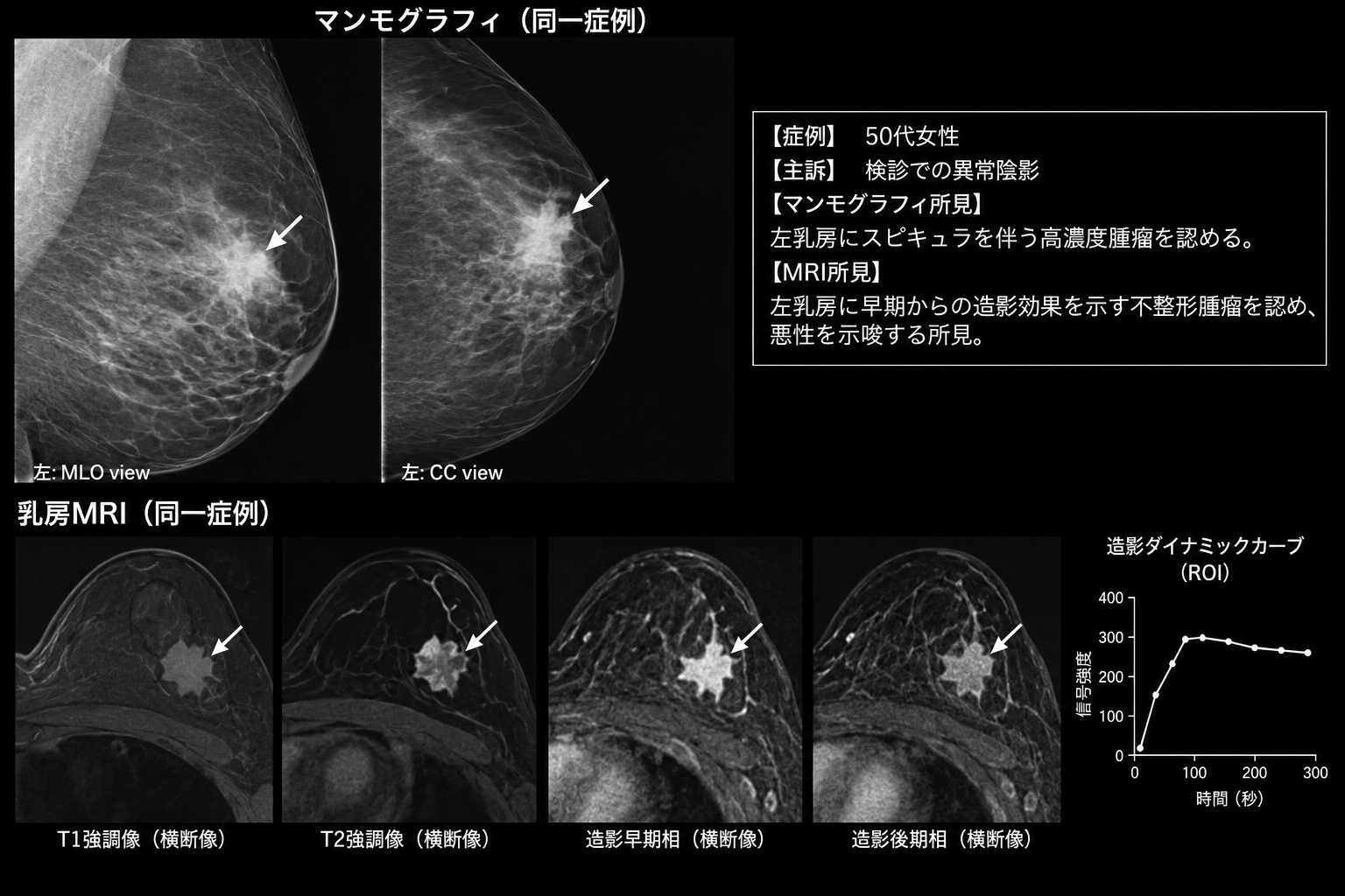 乳房超音波画像