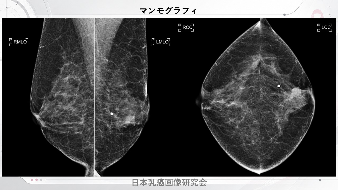 症例1 マンモグラフィ