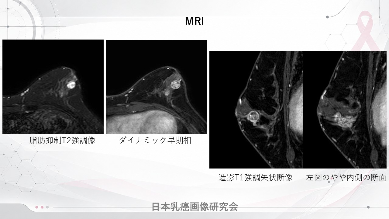 症例1 乳房MRI