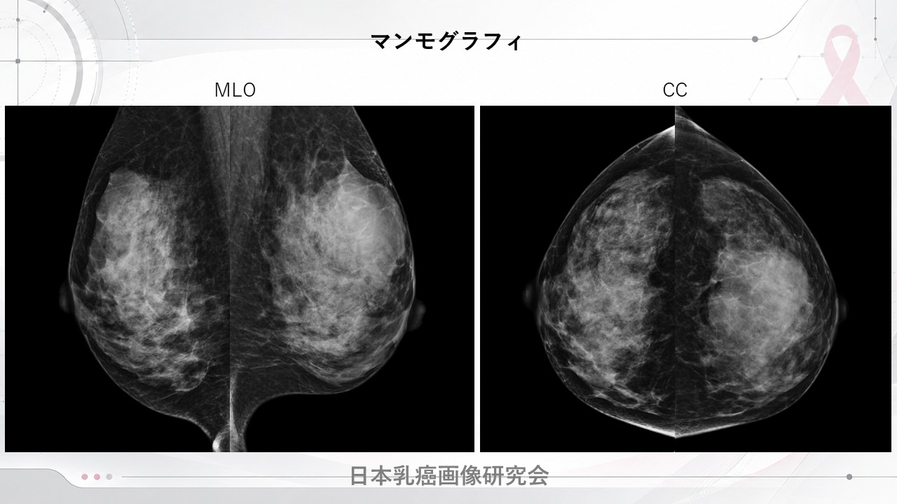症例1 マンモグラフィ