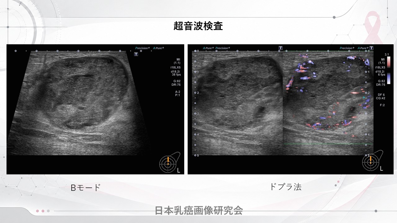 症例1 乳房超音波