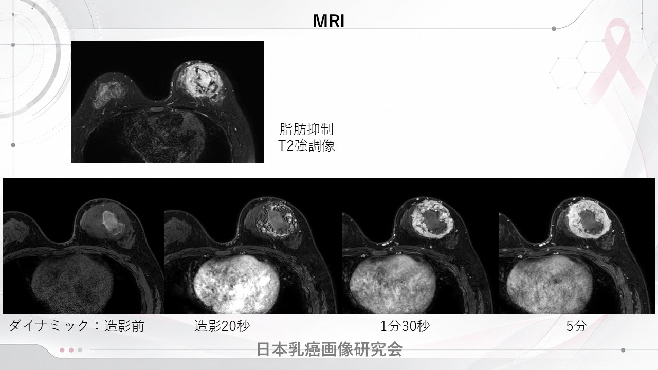 症例1 乳房MRI